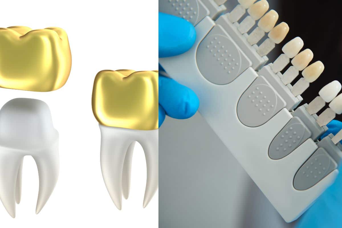 Dental Crowns vs. Veneers