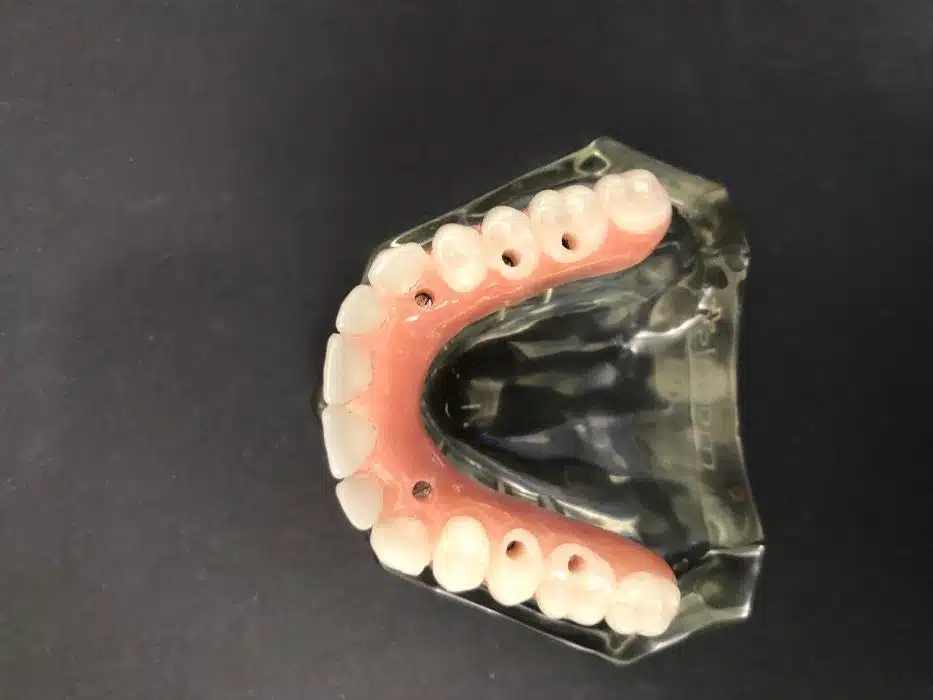 Dental prosthetic model showing upper teeth arrangement with pink gums and white teeth against dark background.