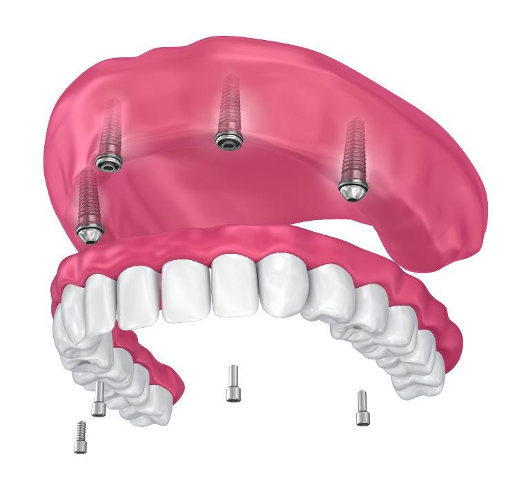 Digital illustration of dental implants in upper and lower jaw with pink gum model and metal implant posts.
