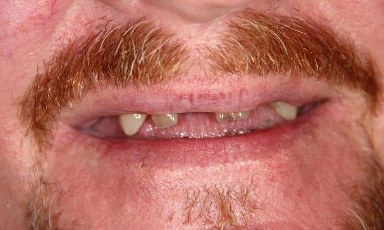 Close-up of mouth showing dental condition with missing and damaged teeth requiring dental care.