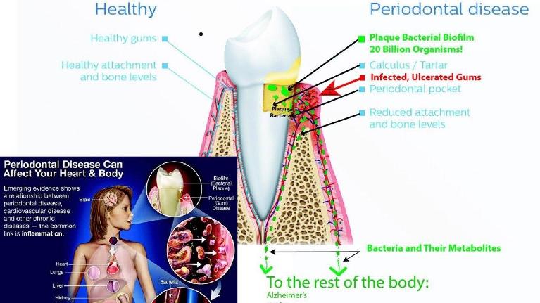 Dental diagram comparing healthy teeth to periodontal disease with anatomical labels and infection details.