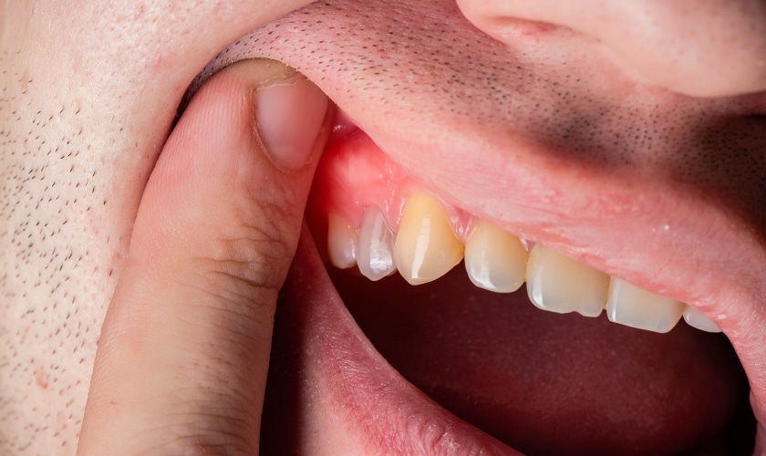PERIODONTAL DISEASE