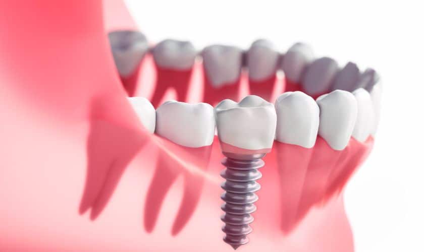 How Safe Are Dental Implants For Diabetics?