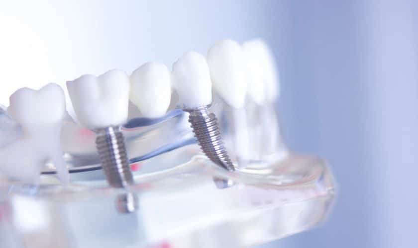 How Many Teeth Can Dental Implants Replace?