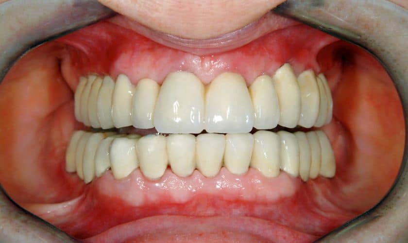 The Importance Of Gum Health In Full Mouth Reconstruction