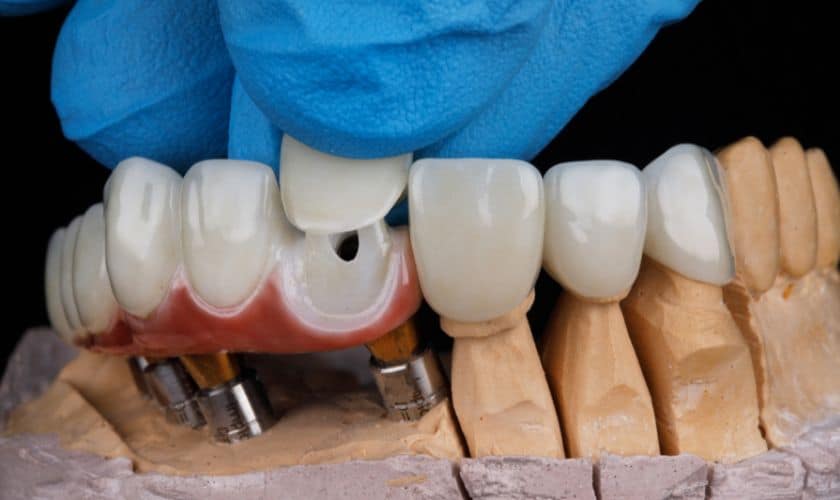 How Hybrid Dentistry Is Revolutionizing Tooth Replacement