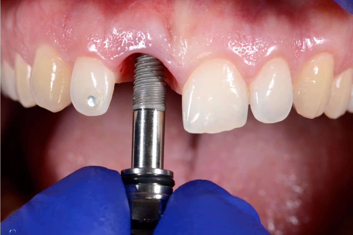 Upper hybrid-teeth screwed into implants