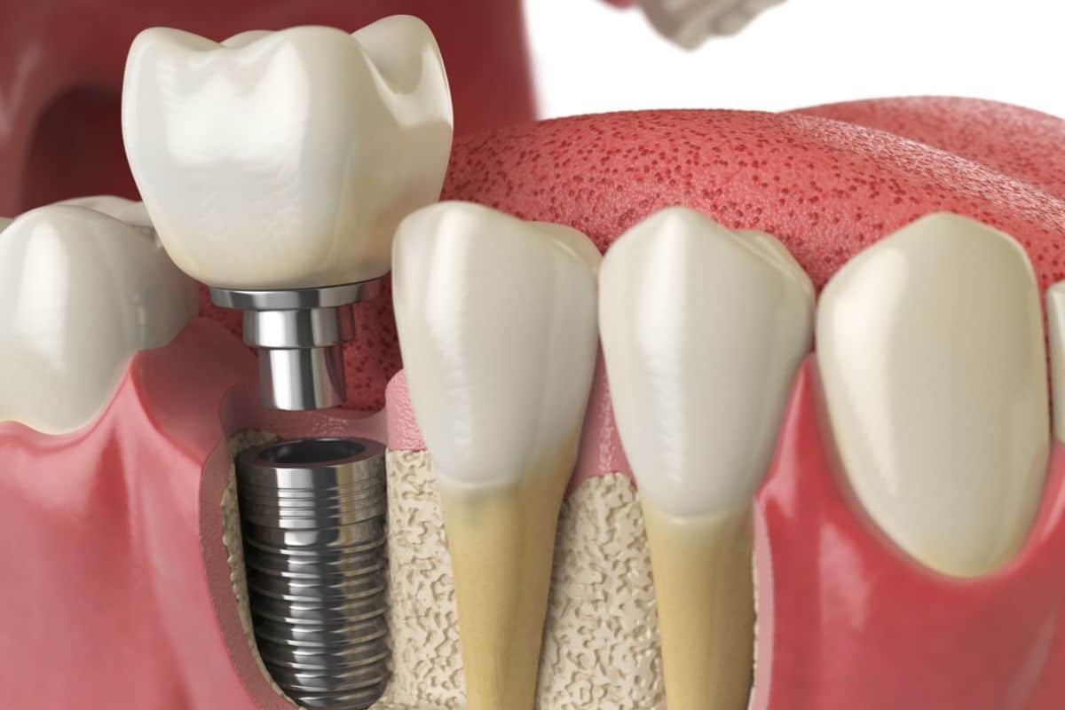 Dental implant model showing titanium screw, abutment, and crown alongside natural teeth