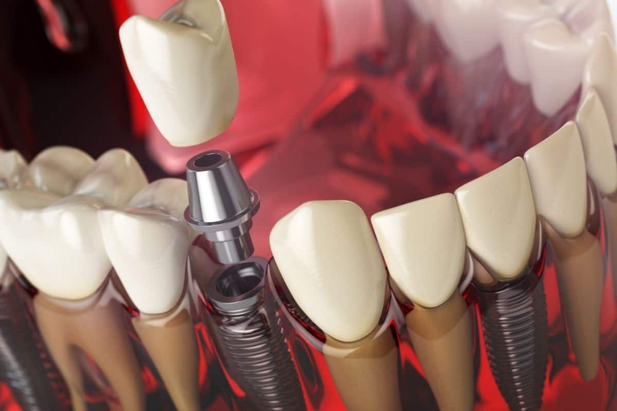 Dental implant model showing tooth replacement procedure with implant fixture and crown positioning.